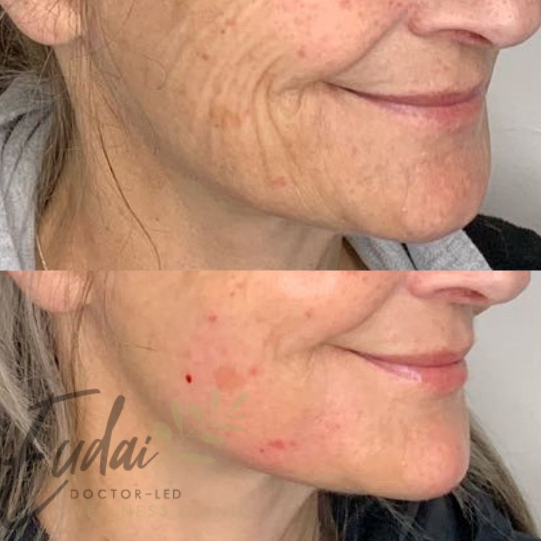 Before and after close-up comparison of a woman's lower face showing improved skin texture and reduction of wrinkles, with the Eudai Clinic logo in the bottom image.