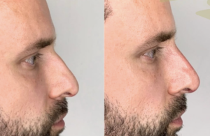 Liquid Rhinoplasty - Eudai Clinic, Beeston, Nottingham - Doctor led service by Dr Dimi